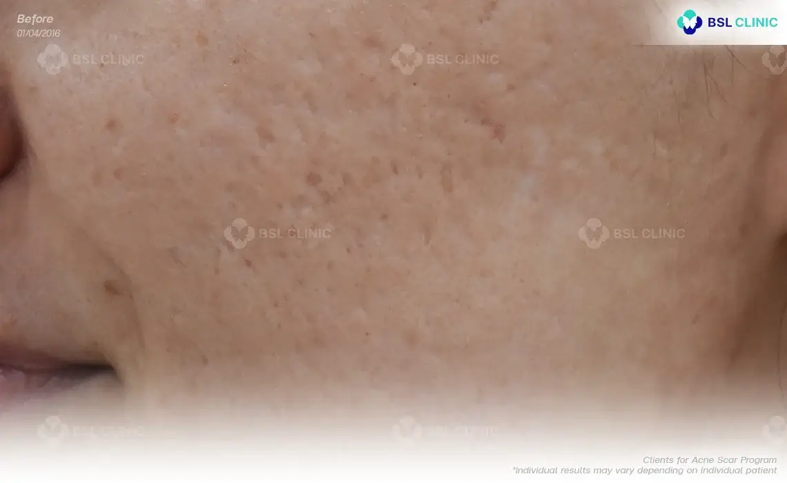 before acne scar program