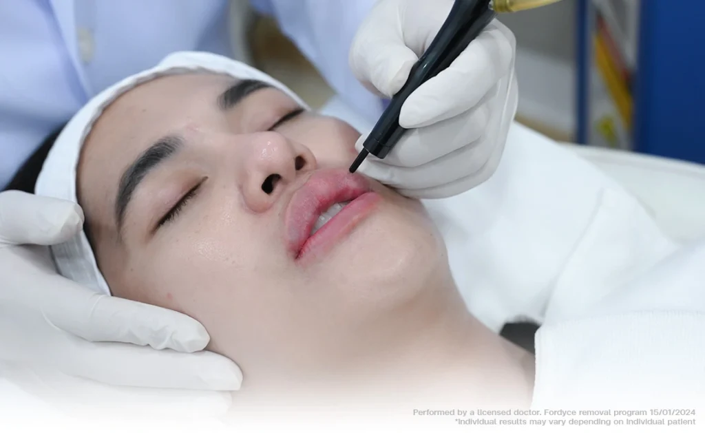 micro pulse co2 laser treatment upper lip fordyce spot removal skin tag milia smooth healing bsl clinic