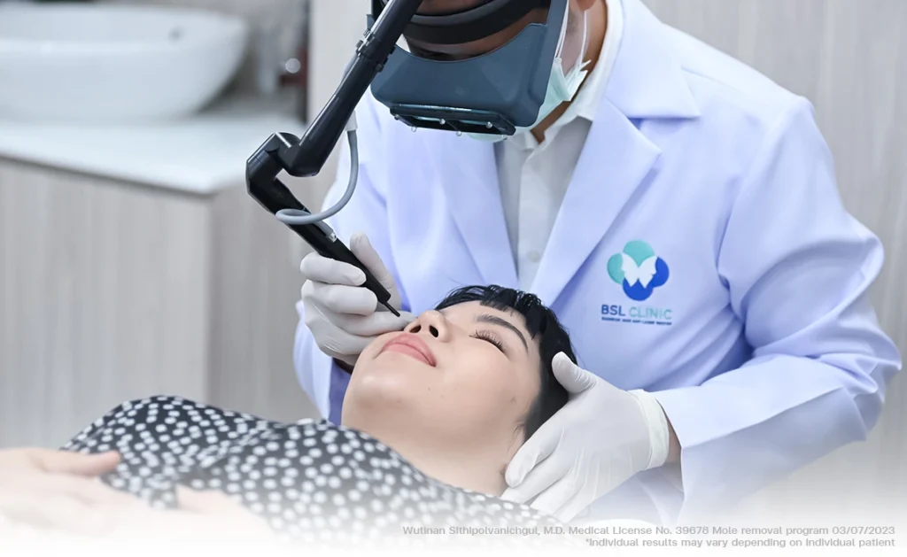mole removal with co2 laser near eyelid skin tag and facial lesion treatment bsl clinic