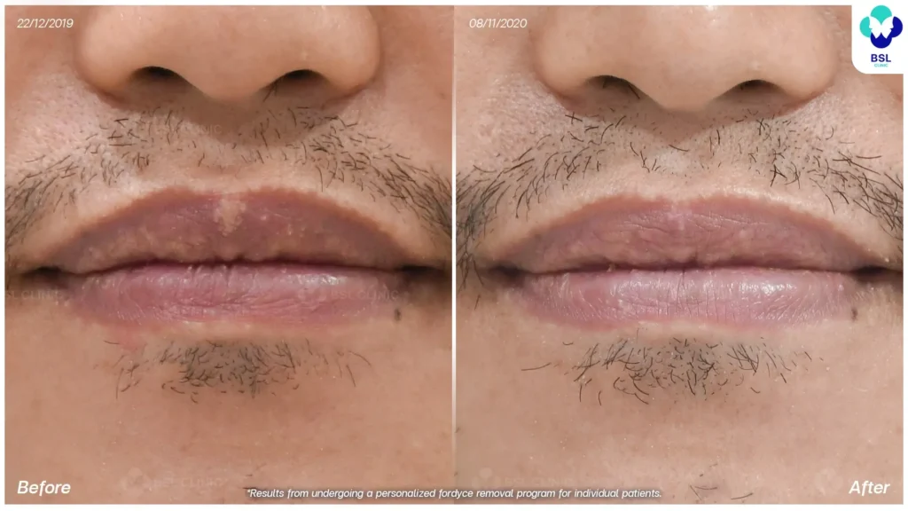 lip bump removal before and after using co2 laser bangkok bsl clinic thailand for fordyce spot milia and skin tag removal co2 laser bangkok price mole removal thailand results 04