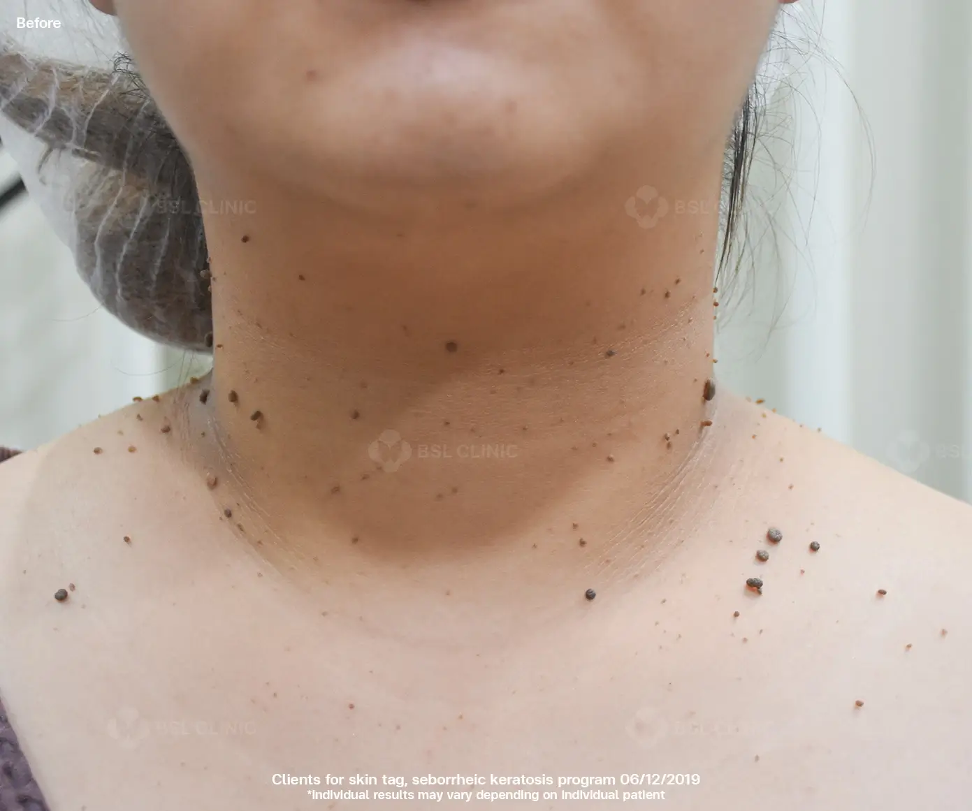 before and after skin tag and seborrheic keratosis removal on neck using co2 laser bangkok bsl clinic thailand safe procedure for clear skin milia syringoma skin tag removal thailand co2 laser bangkok price results 01