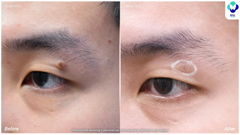 before and after skin tag removal bangkok using co2 laser thailand bsl clinic safe precise treatment for mole removal milia syringoma and pre cancerous lesions such as actinic keratosis co2 laser bangkok price skin tag removal thailand bangkok mole removal results 03