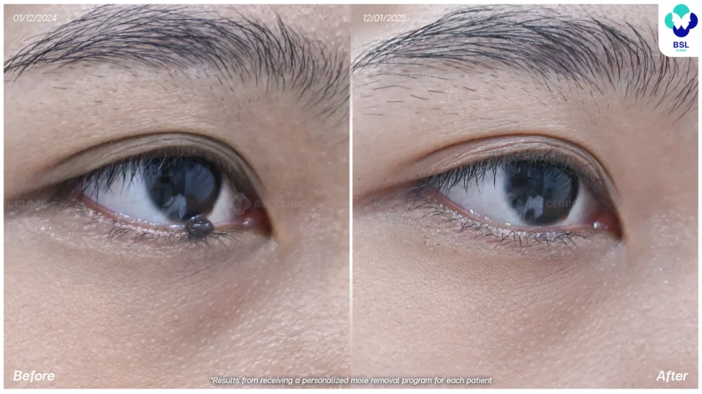 before and after skin tag removal bangkok using co2 laser thailand bsl clinic safe precise treatment for mole removal milia syringoma and pre cancerous lesions such as actinic keratosis co2 laser bangkok price skin tag removal thailand bangkok mole removal results
