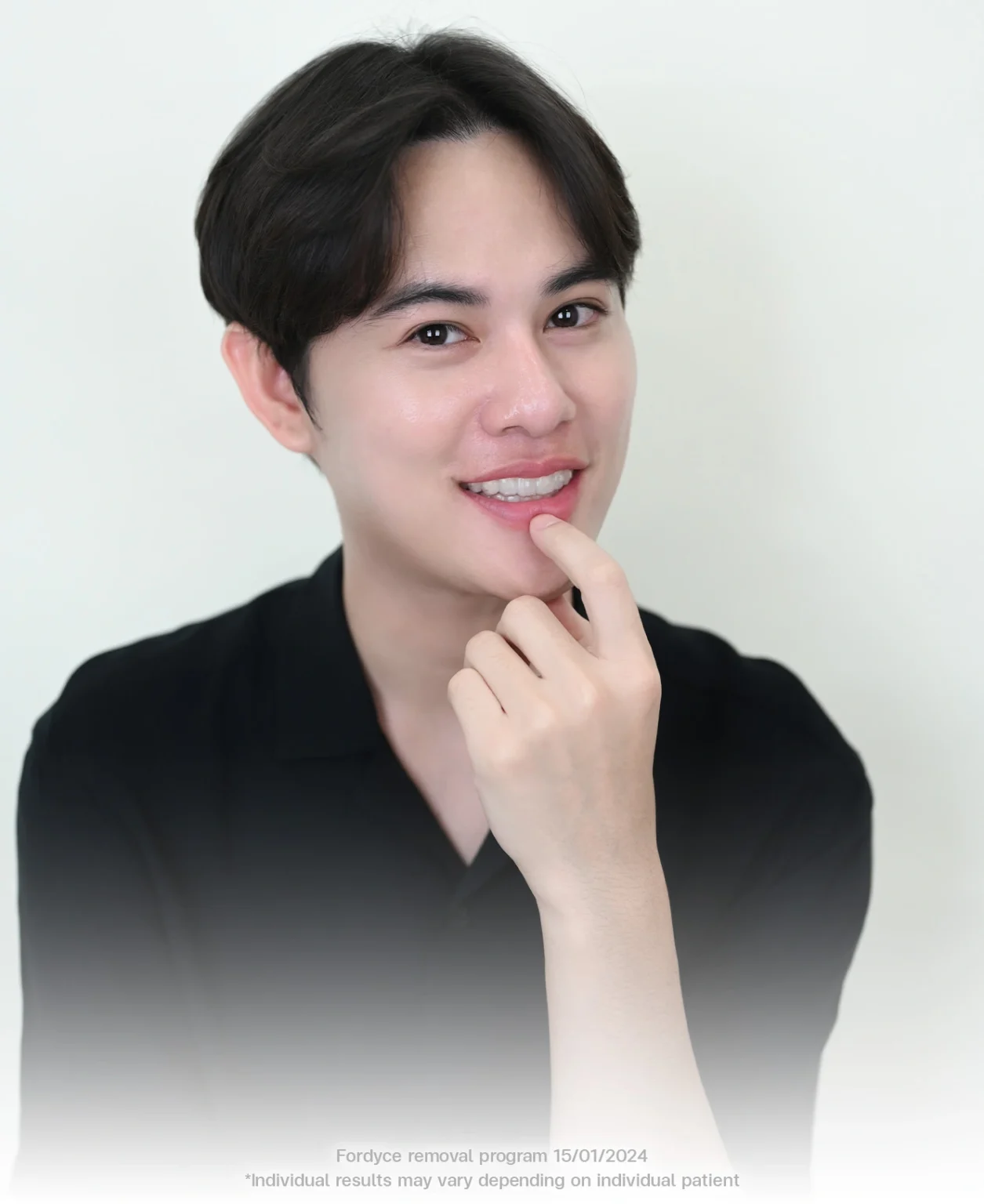 fordyce spot removal bangkok using co2 laser at bsl clinic thailand safe treatment for lip bumps milia syringoma and skin tag removal co2 laser bangkok price skin tag removal thailand bangkok mole removal clear skin results co2 laser thailand for fordyce spots