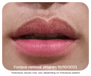 before and after fordyce spot removal on lips using co2 laser bangkok at bsl clinic thailand precise safe treatment for skin tag removal milia syringoma and small facial bumps co2 laser bangkok price skin tag removal thailand bangkok mole removal results