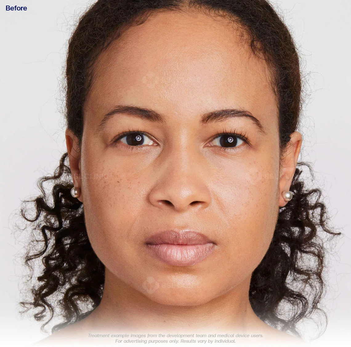 ultherapy-prime-ultherapy-before-and-after-180-days-ultherapy-results-01