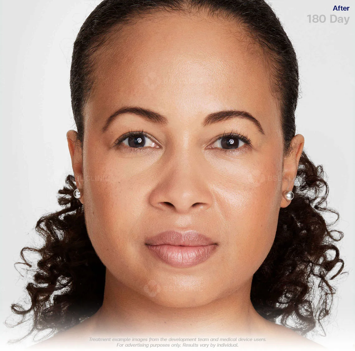 ultherapy-prime-ultherapy-before-and-after-180-days-ultherapy-results-02