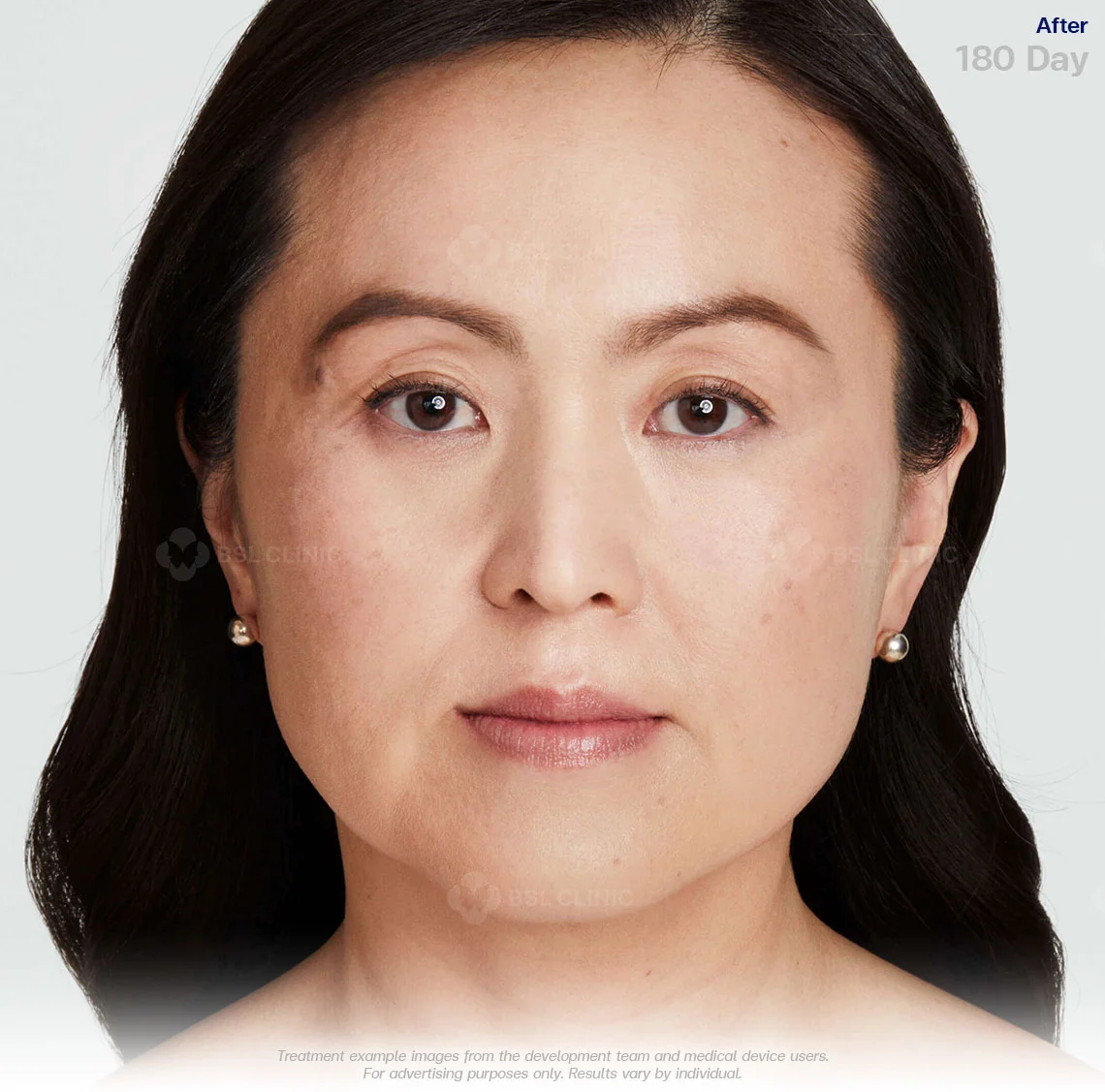 ultherapy prime before and after results 180 days ulthera bangkok ultherapy bangkok price non invasive face lift ultherapy treatment ultherapy thailand ultherapy face lift cost ultherapy bangkok best ultherapy in bangkok