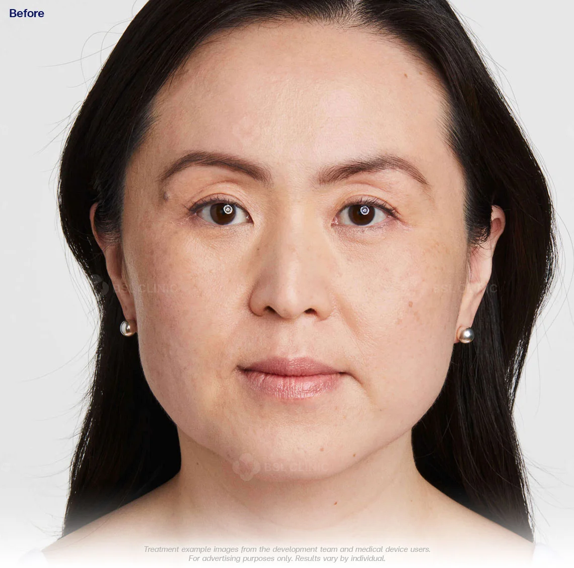 ultherapy prime ultherapy before and after 180 days ultherapy results