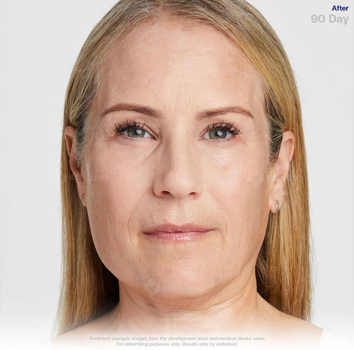 ultherapy prime ultherapy before and after 90 days ultherapy results