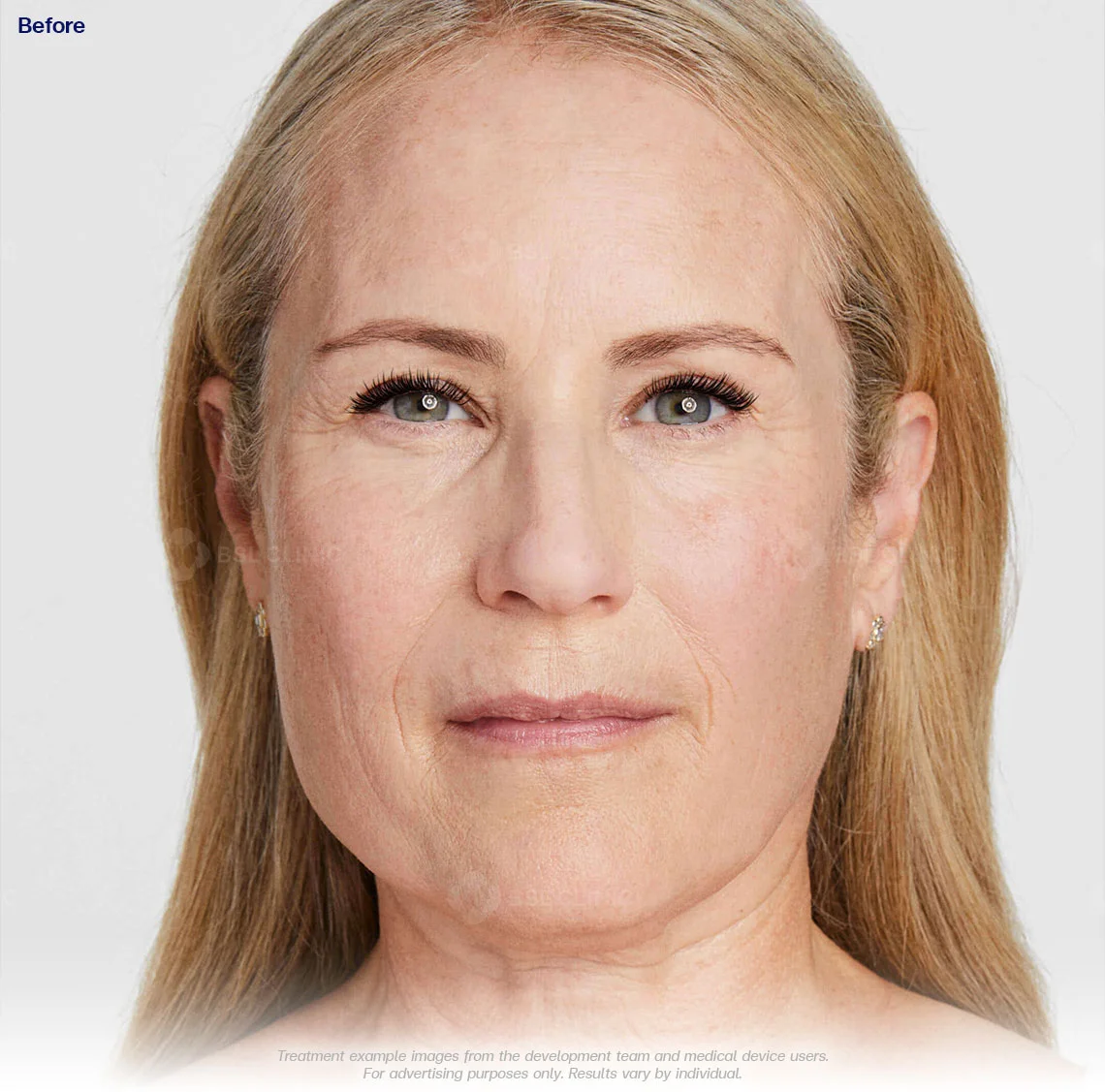 ultherapy prime ultherapy before and after 90 days ultherapy results