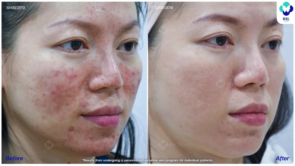 โปรแกรมรักษาผิวแพ้ง่าย *ใช้เป็นตัวอย่างผลจากการเข้ารับการรักษาพยาบาลสำหรับผู้ป่วยเฉพาะราย