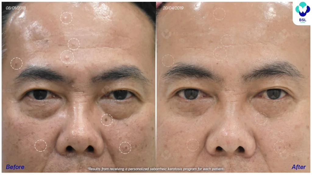 โปรแกรมเลเซอร์รักษาไฝ ขี้แมลงวัน ติ่งเนื้อ กระเนื้อ  *ใช้เป็นตัวอย่างผลจากการเข้ารับการรักษาพยาบาลสำหรับผู้ป่วยเฉพาะราย
