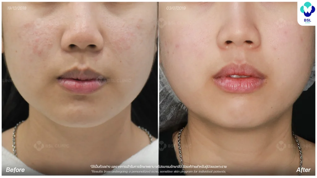 รีวิวรักษาสิว ภาพการรักษาผู้ใช้บริการ BSL Clinic