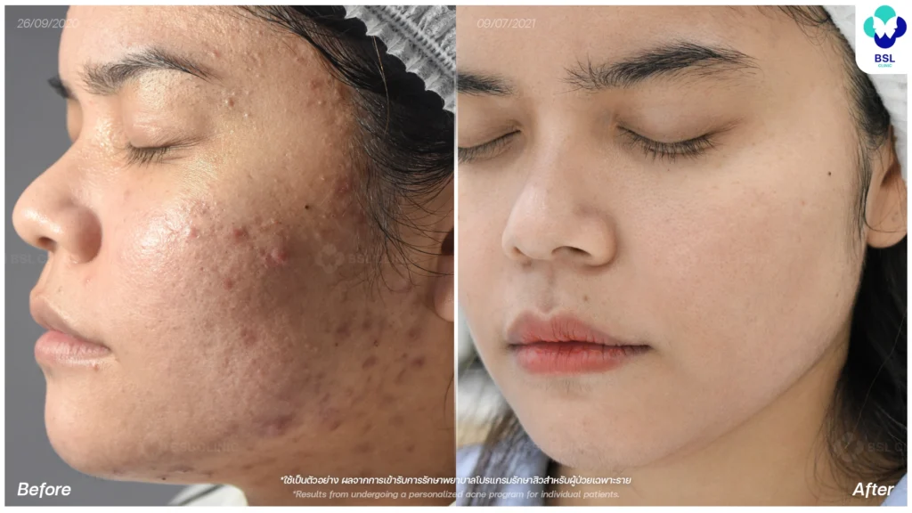 รีวิวรักษาสิว ภาพการรักษาผู้ใช้บริการ BSL Clinic