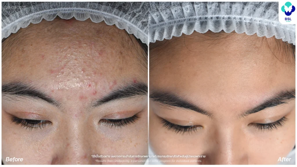 รีวิวรักษาสิว ภาพการรักษาผู้ใช้บริการ BSL Clinic