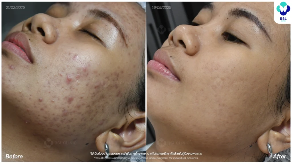 รีวิวรักษาสิว ภาพการรักษาผู้ใช้บริการ BSL Clinic