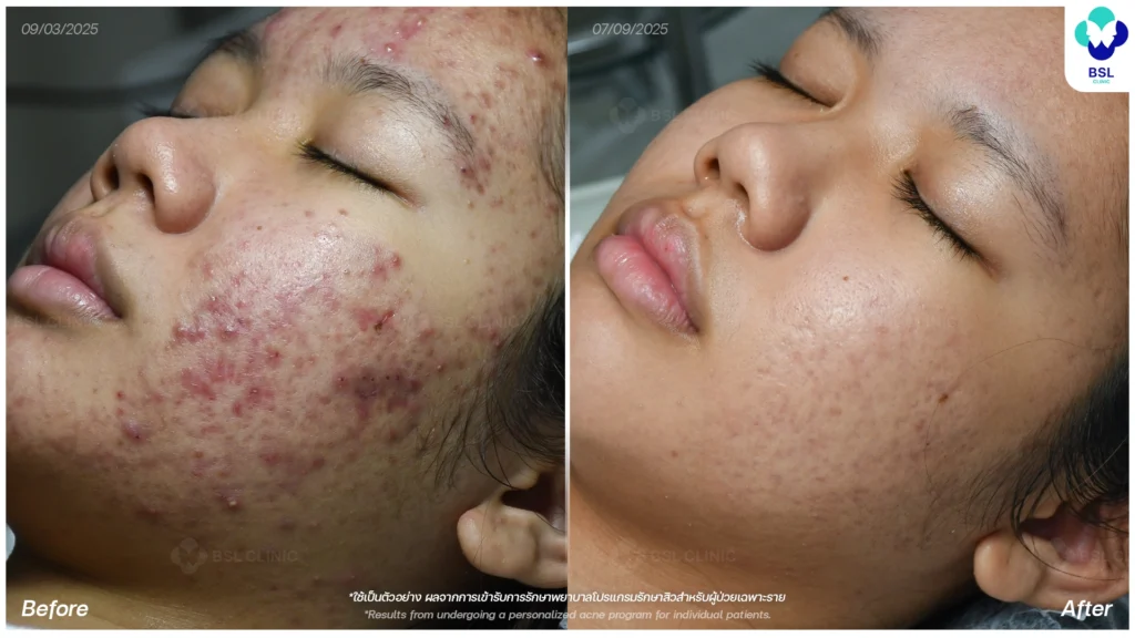 รีวิวรักษาสิว ภาพการรักษาผู้ใช้บริการ BSL Clinic