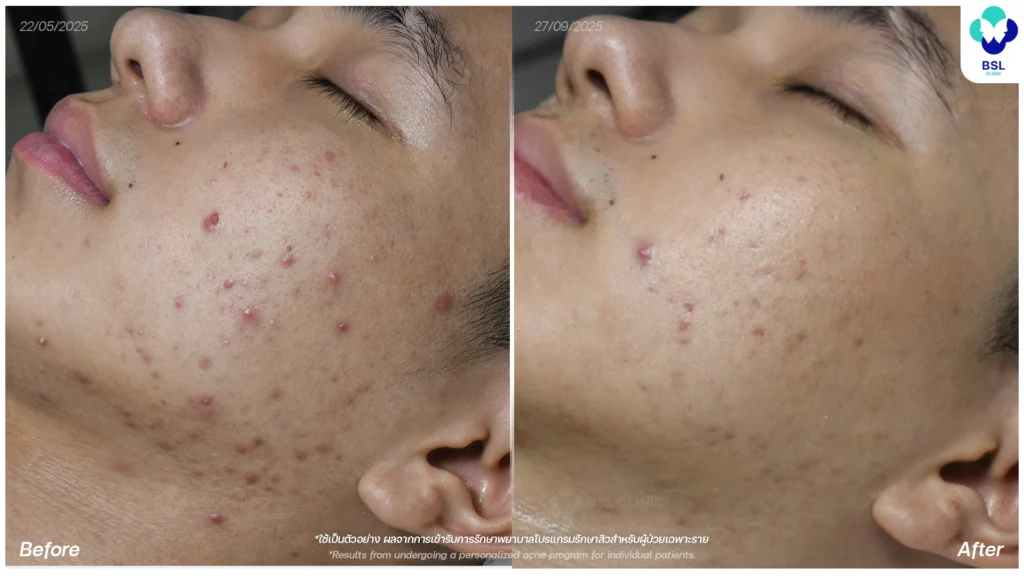 รีวิวรักษาสิว ภาพการรักษาผู้ใช้บริการ BSL Clinic