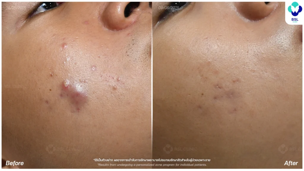 รีวิวรักษาสิว ภาพการรักษาผู้ใช้บริการ BSL Clinic