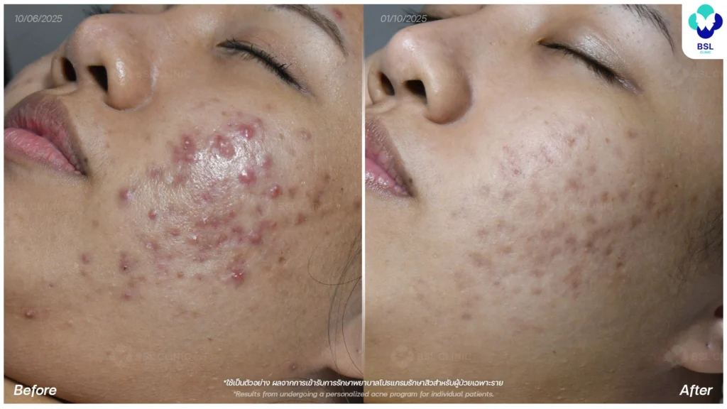 รีวิวรักษาสิว ภาพการรักษาผู้ใช้บริการ BSL Clinic
