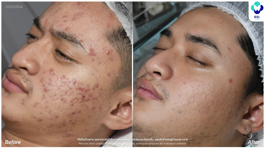 รีวิวรักษาสิว ภาพการรักษาผู้ใช้บริการ BSL Clinic