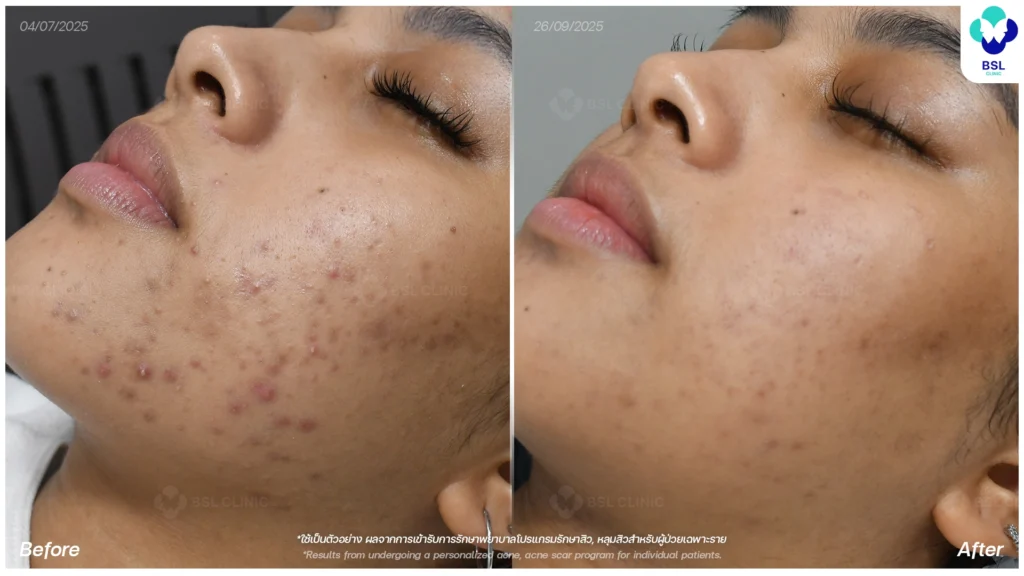 รีวิวรักษาสิว ภาพการรักษาผู้ใช้บริการ BSL Clinic