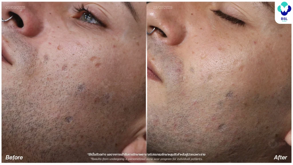รีวิวรักษาสิว ภาพการรักษาผู้ใช้บริการ BSL Clinic