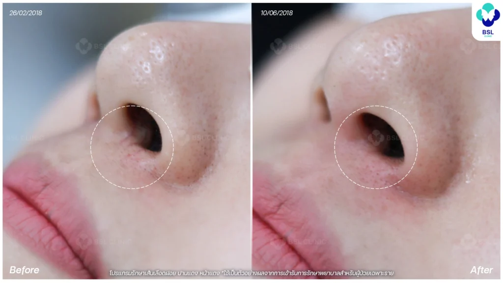 รีวิวรักษารอยแดง เส้นเลือดฝอย รอยเส้นเลือดขอดที่รบกวนความมั่นใจ