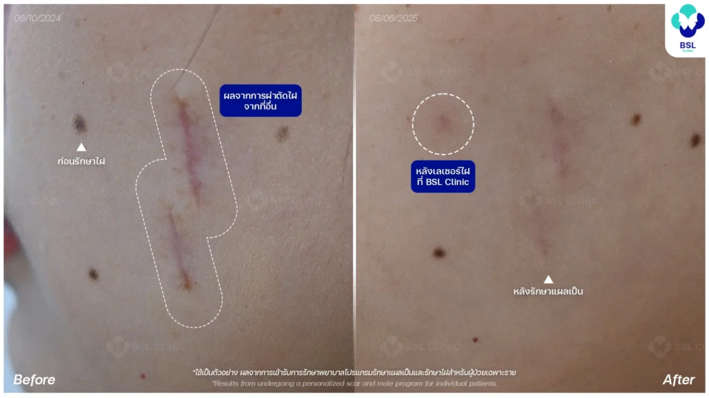 โปรแกรมเลเซอร์รักษาไฝ ขี้แมลงวัน ติ่งเนื้อ กระเนื้อ  *ใช้เป็นตัวอย่างผลจากการเข้ารับการรักษาพยาบาลสำหรับผู้ป่วยเฉพาะราย