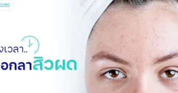 5-วิธี-ที่รักษาสิวผดให้หายได้จริง