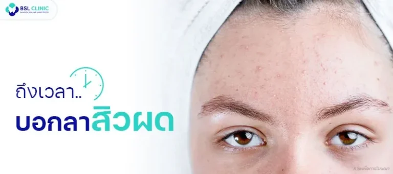 5-วิธี-ที่รักษาสิวผดให้หายได้จริง