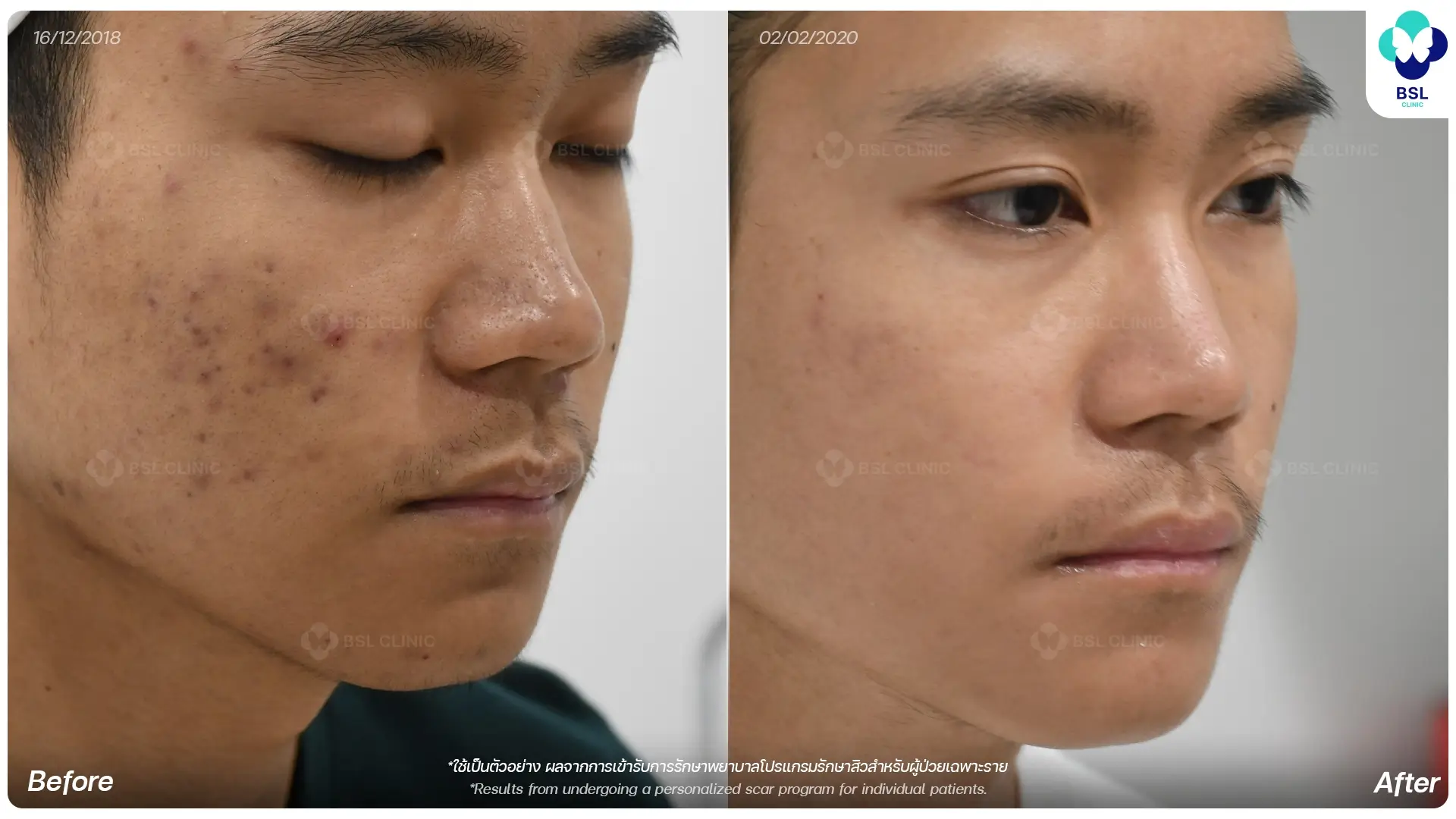 รักษาสิว
