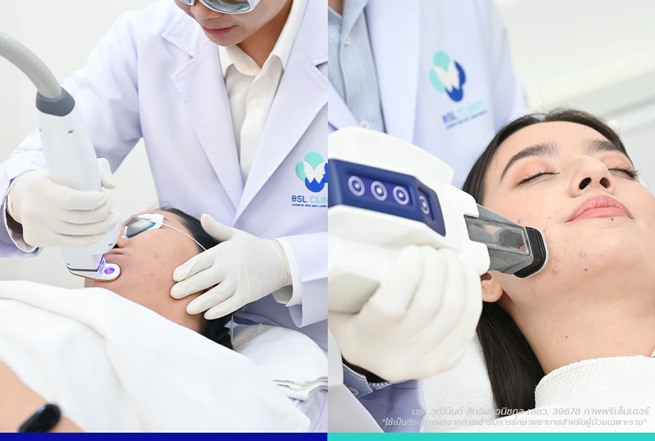 โปรแกรม Accure & AviClear