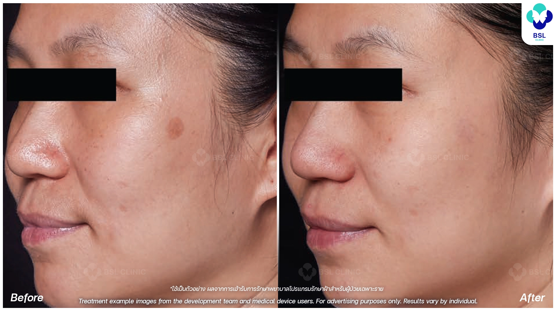 picoway laser before and after for pigmentation dark spots and uneven skin tone pico laser treatment bangkok thailand bsl clinic