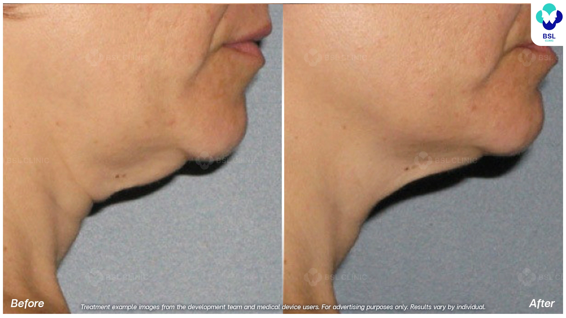 before after result face lift