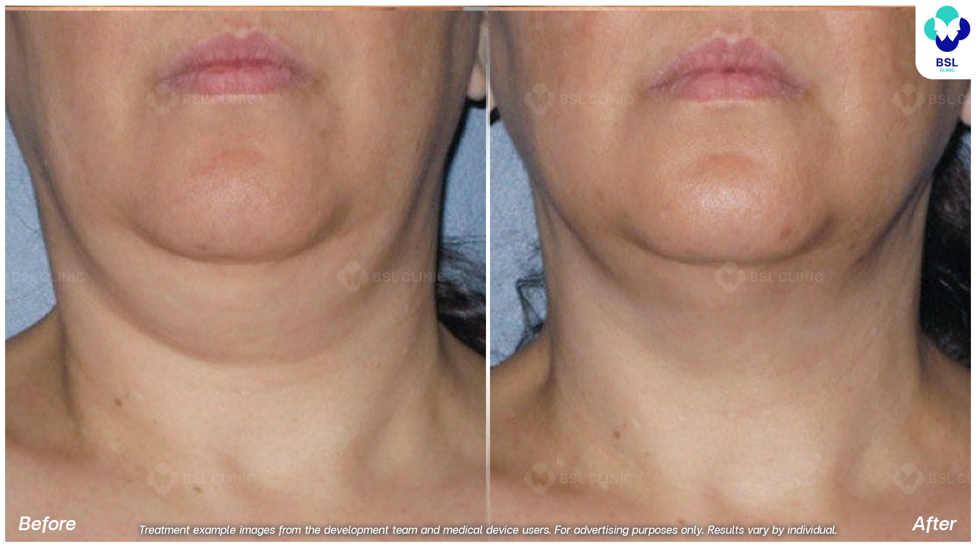 before after result face lift