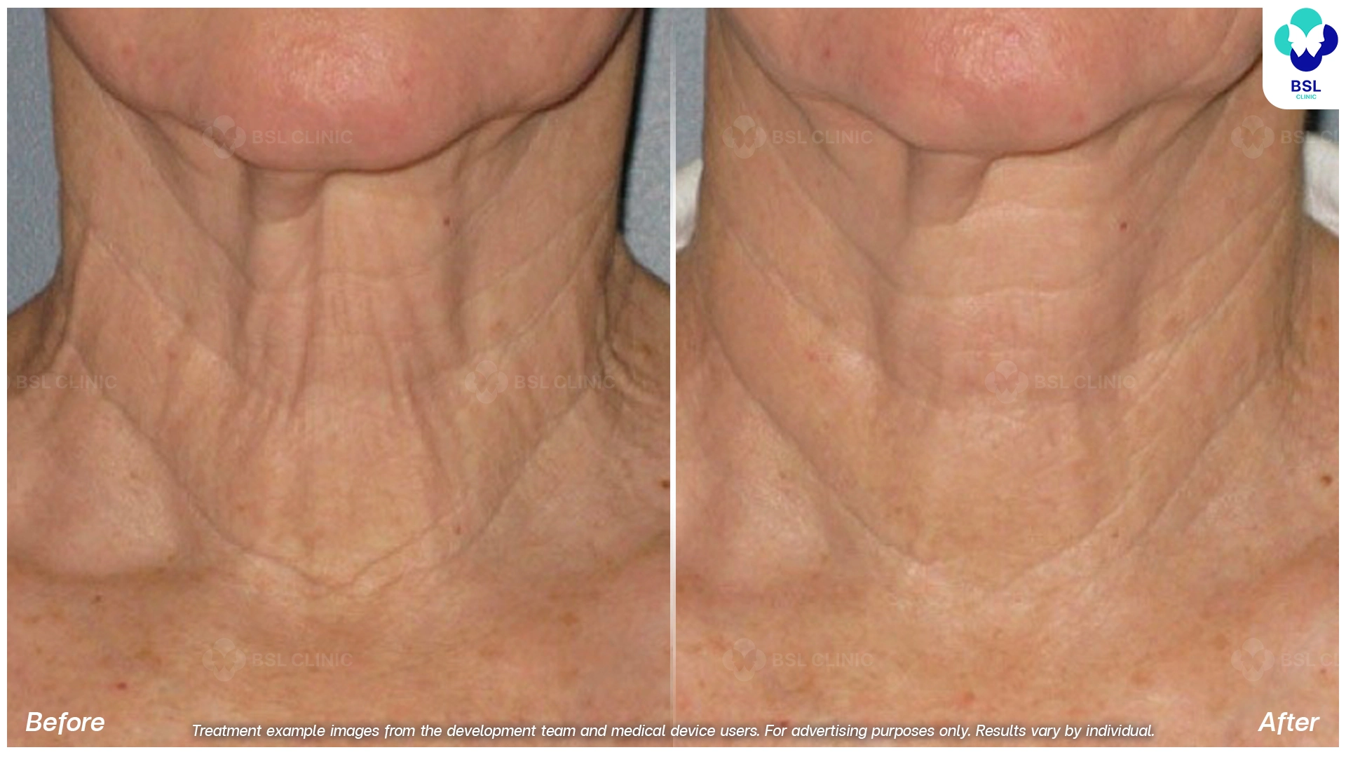 before after result face lift