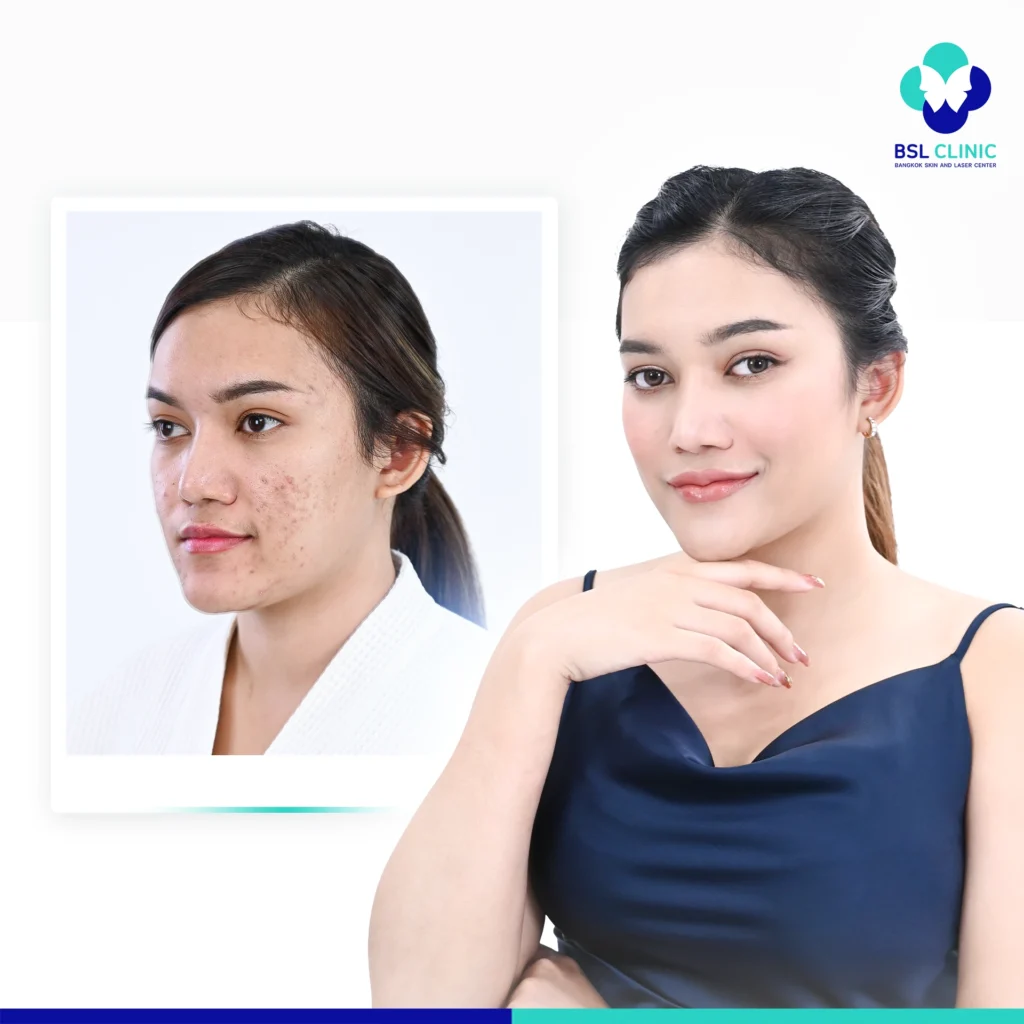 กิจกรรมรักษาสิวฟรี Season 1 BSL Clinic