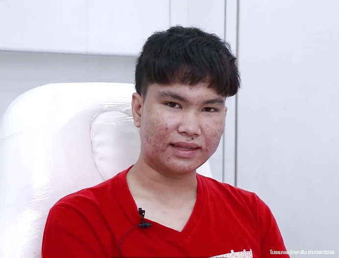 CSR-รักษาสิวฟรี-น้องยะ-ธนวัฒน์