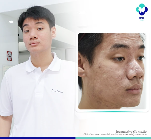 โครงการรักษาสิวฟรี Season 1 BSL Clinic