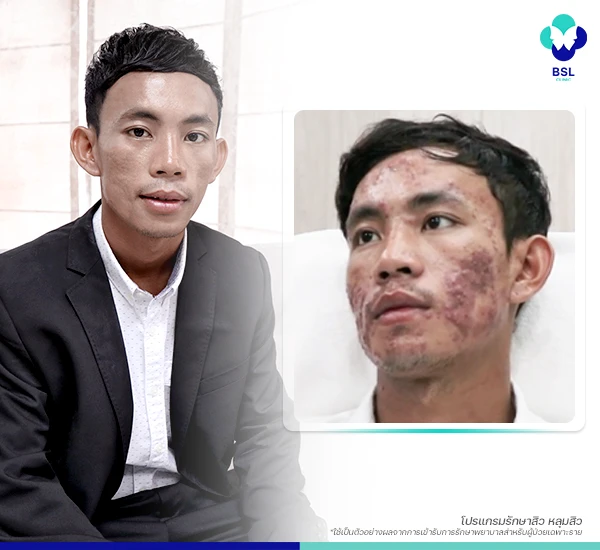 CSR-โครงการรักษาสิวฟรี-Season-2-คุณสด