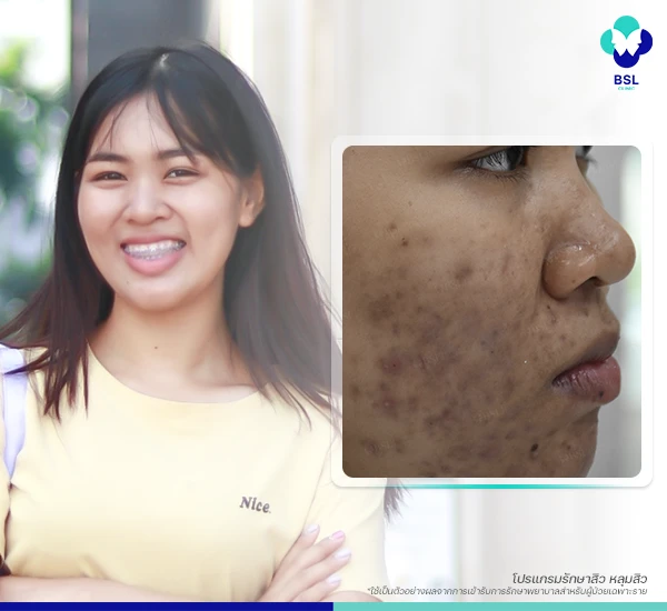 โครงการรักษาสิวฟรี Season 3 BSL Clinic