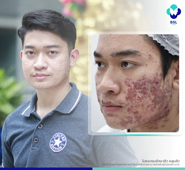 โครงการรักษาสิวฟรี Season 4 BSL Clinic