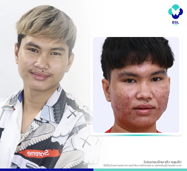 โครงการรักษาสิวฟรี Season 5 BSL Clinic