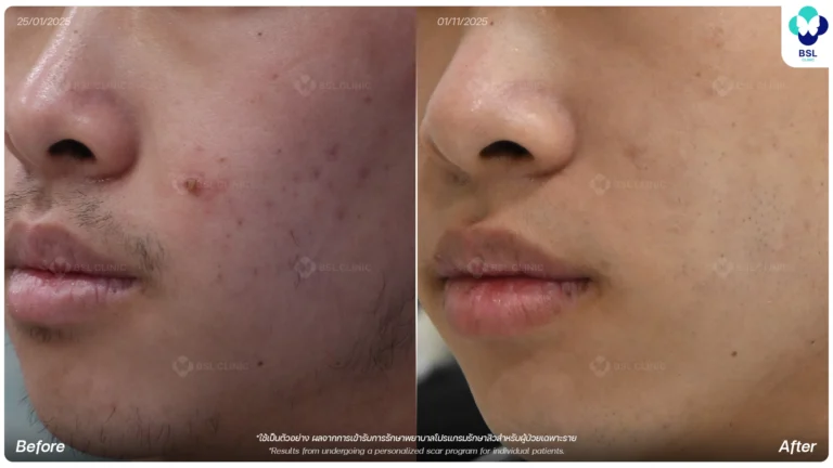 รีวิว Fraxel Laser Program