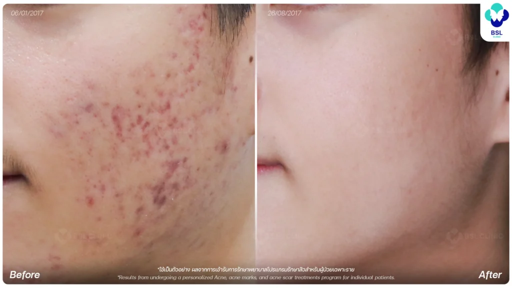 ผลการรักษา โปรแกรมรักษาสิว รอยสิว หลุมสิว คลินิกผิวหนัง รักษาสิว ฝ้า กระ แผลเป็น โดยแพทย์ | BSL ClinicBSL Clinic