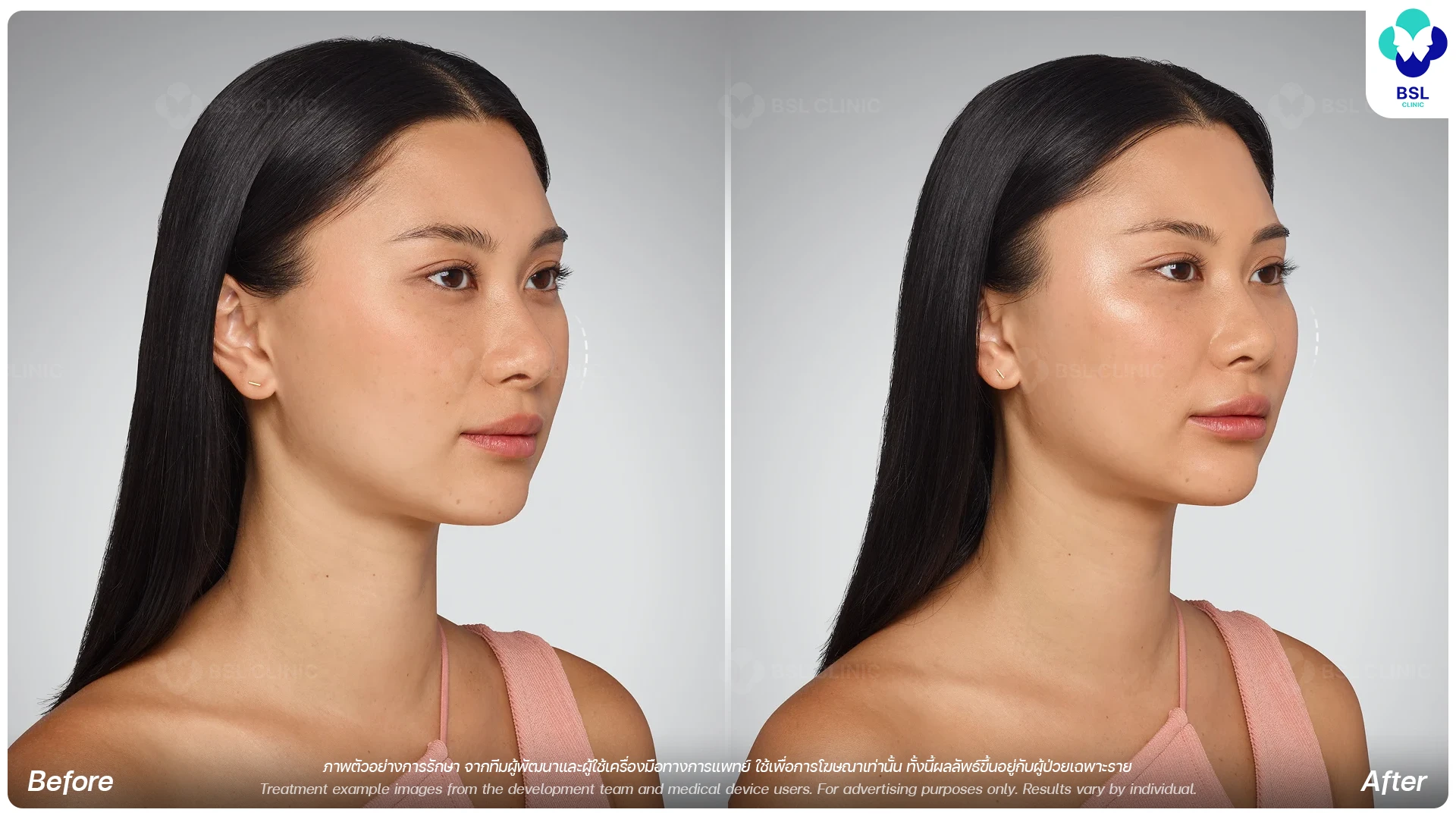 HA Filler Program Cheek Filler Program for Softer Facial Profile
