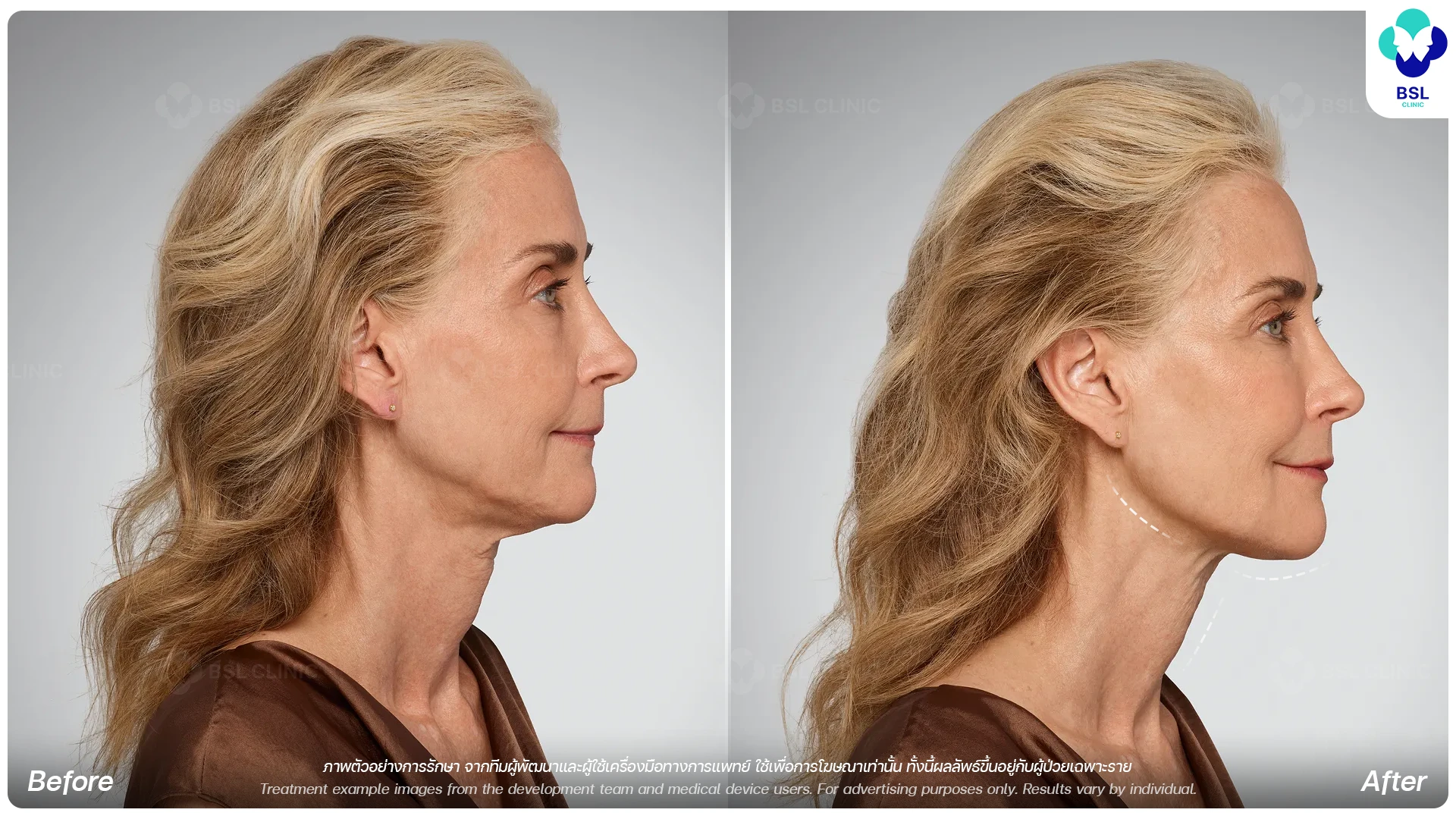 HA Filler Program Jawline Chin Filler Program for Facial Definition