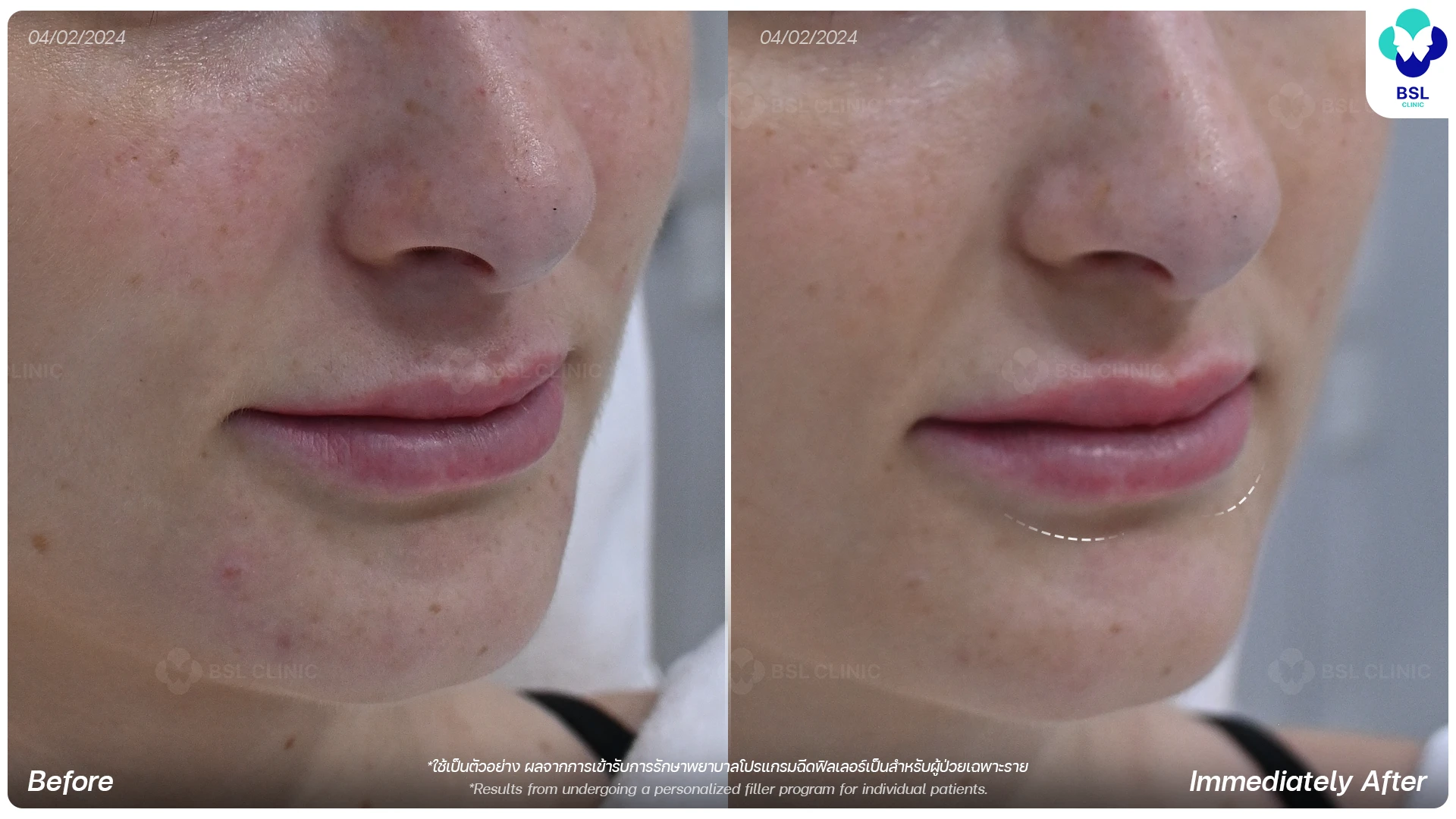 HA Filler Program Lip Filler Program for Natural Lip Contour